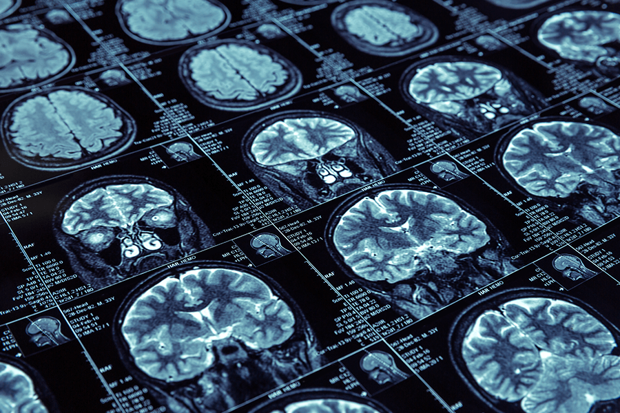 Neuro-Surgery